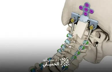 عملية تثبيت الفقرات العنقية