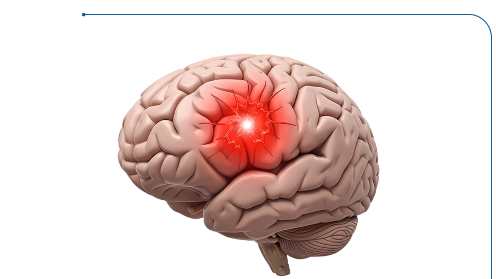 علاج التجمع الدموي في المخ - أحدث الطرق مع الدكتور يسري الحميلي
