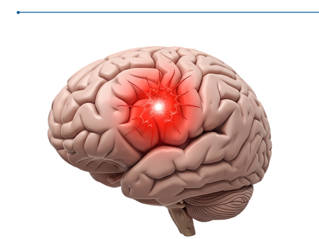 علاج التجمع الدموي في المخ - أحدث الطرق مع الدكتور يسري الحميلي