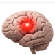 علاج التجمع الدموي في المخ - أحدث الطرق مع الدكتور يسري الحميلي