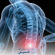 إعوجاج-العمود-الفقري
