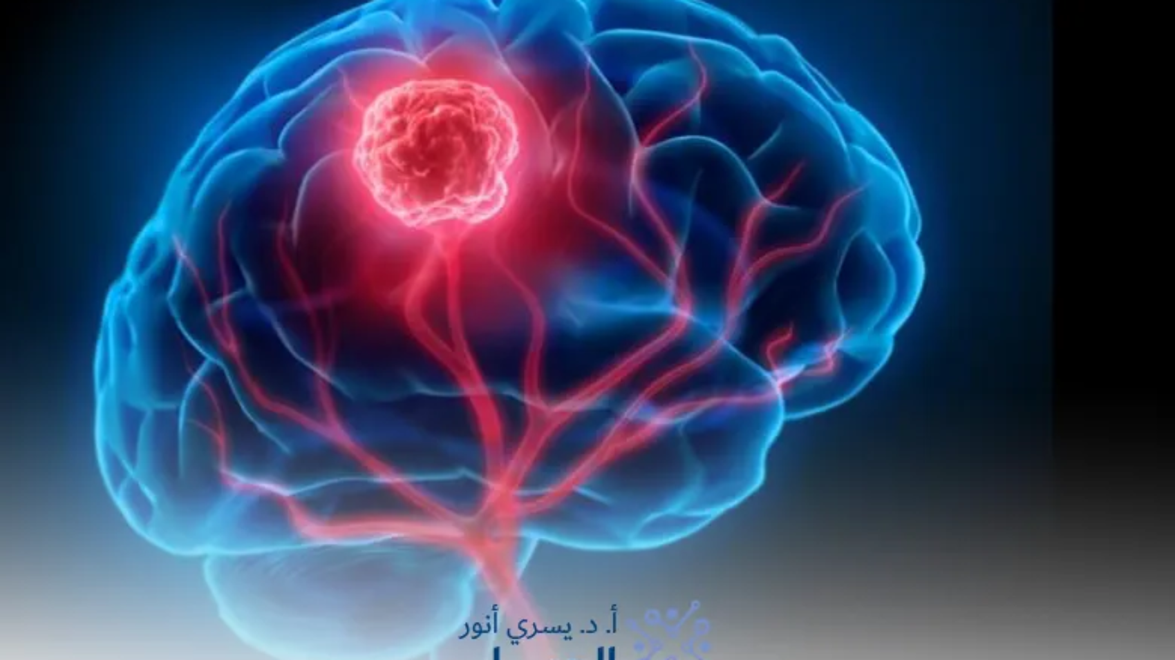 اعراض-ورم-الدماغ-الحميد