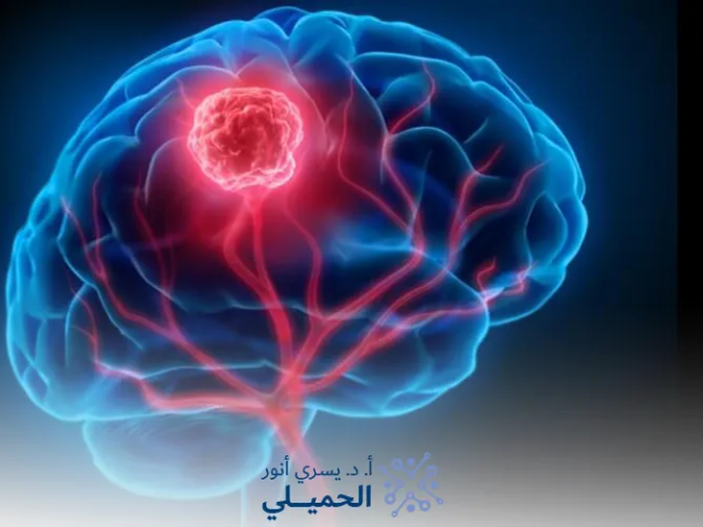 اعراض-ورم-الدماغ-الحميد