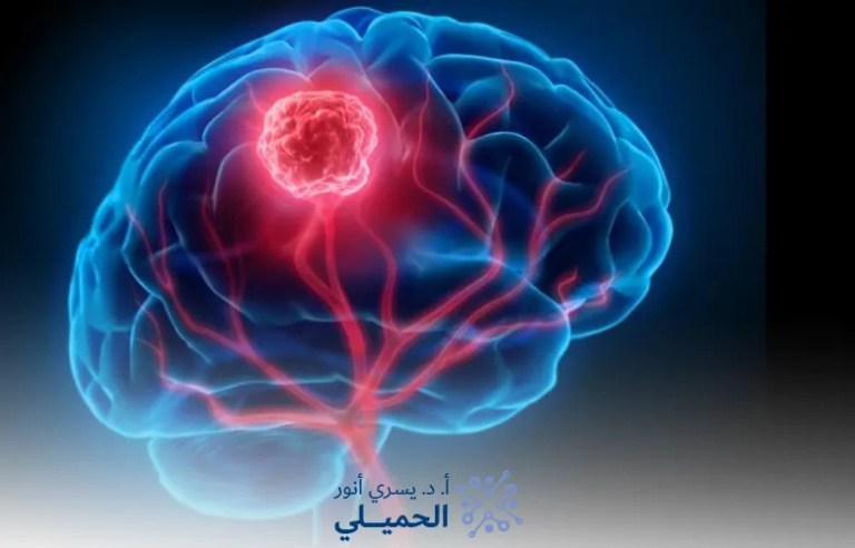 اعراض-ورم-الدماغ-الحميد