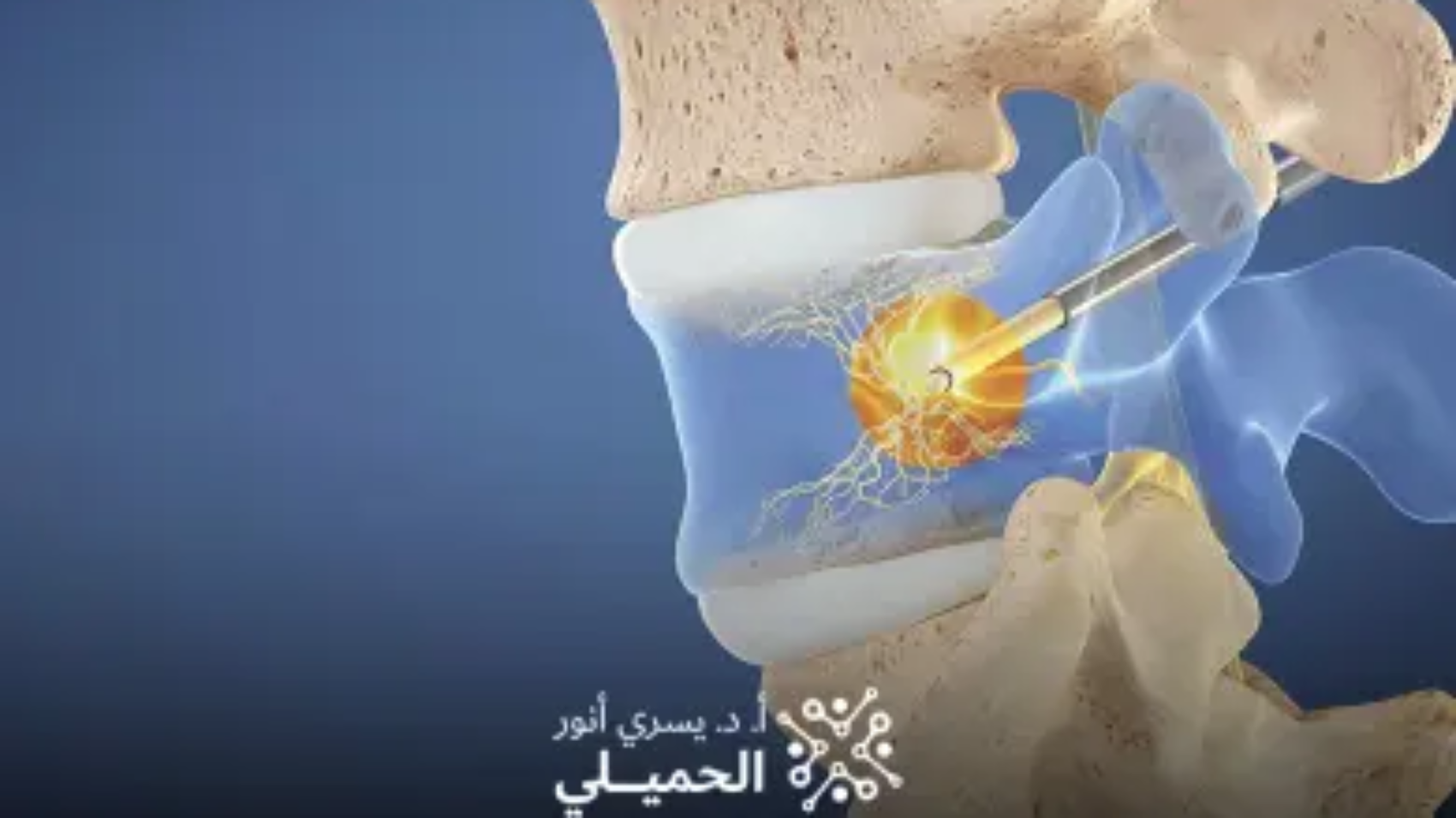 علاج-الانزلاق-الغضروفي-بالليزر-في-مصر (1)
