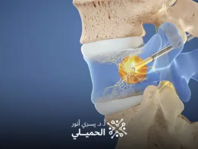 علاج-الانزلاق-الغضروفي-بالليزر-في-مصر (1)