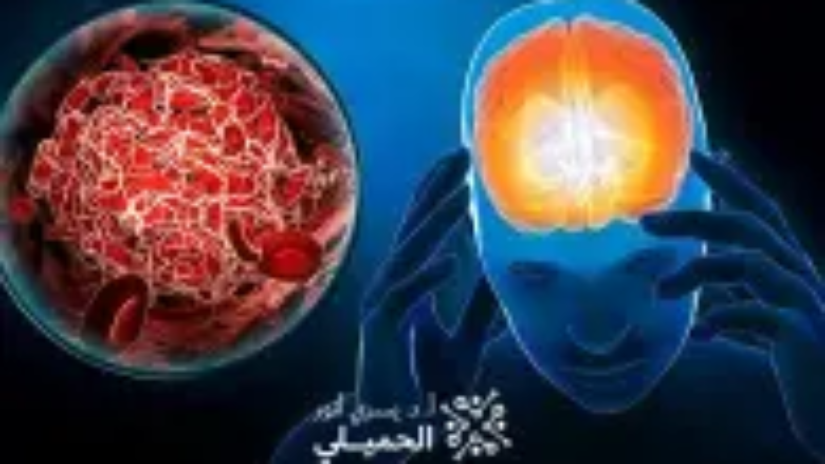 علاج-التجمع-الدموي-في-المخ