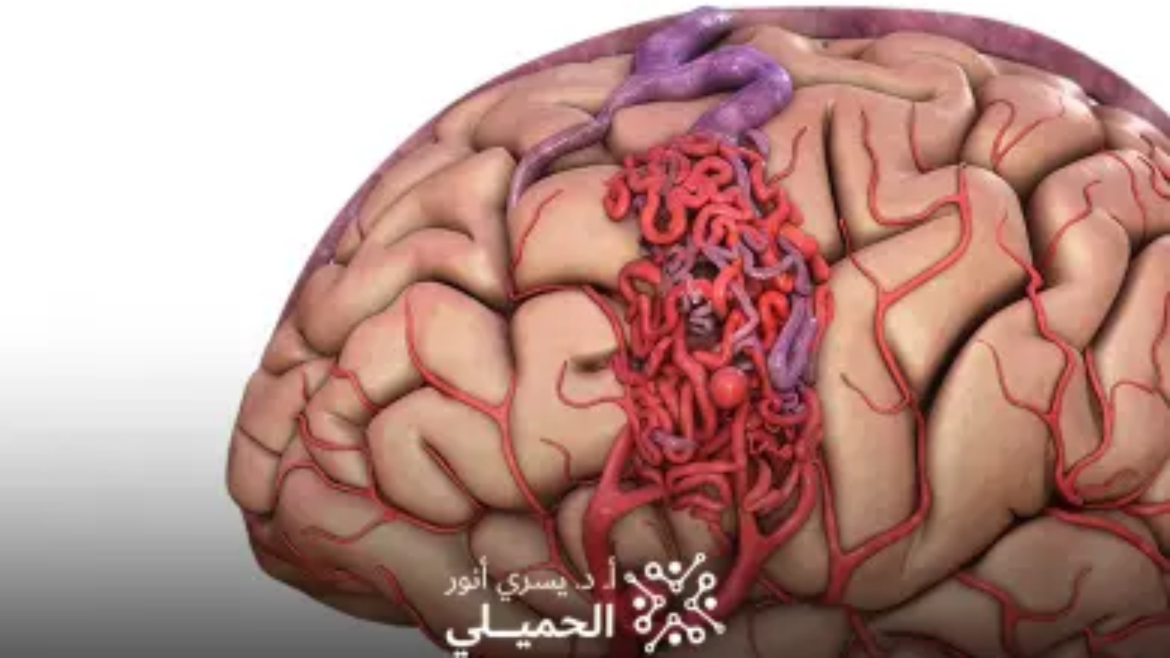 علاج-تمدد-شرايين-المخ