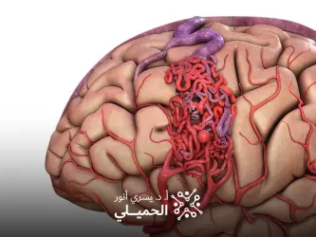 علاج-تمدد-شرايين-المخ