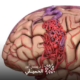 علاج-تمدد-شرايين-المخ