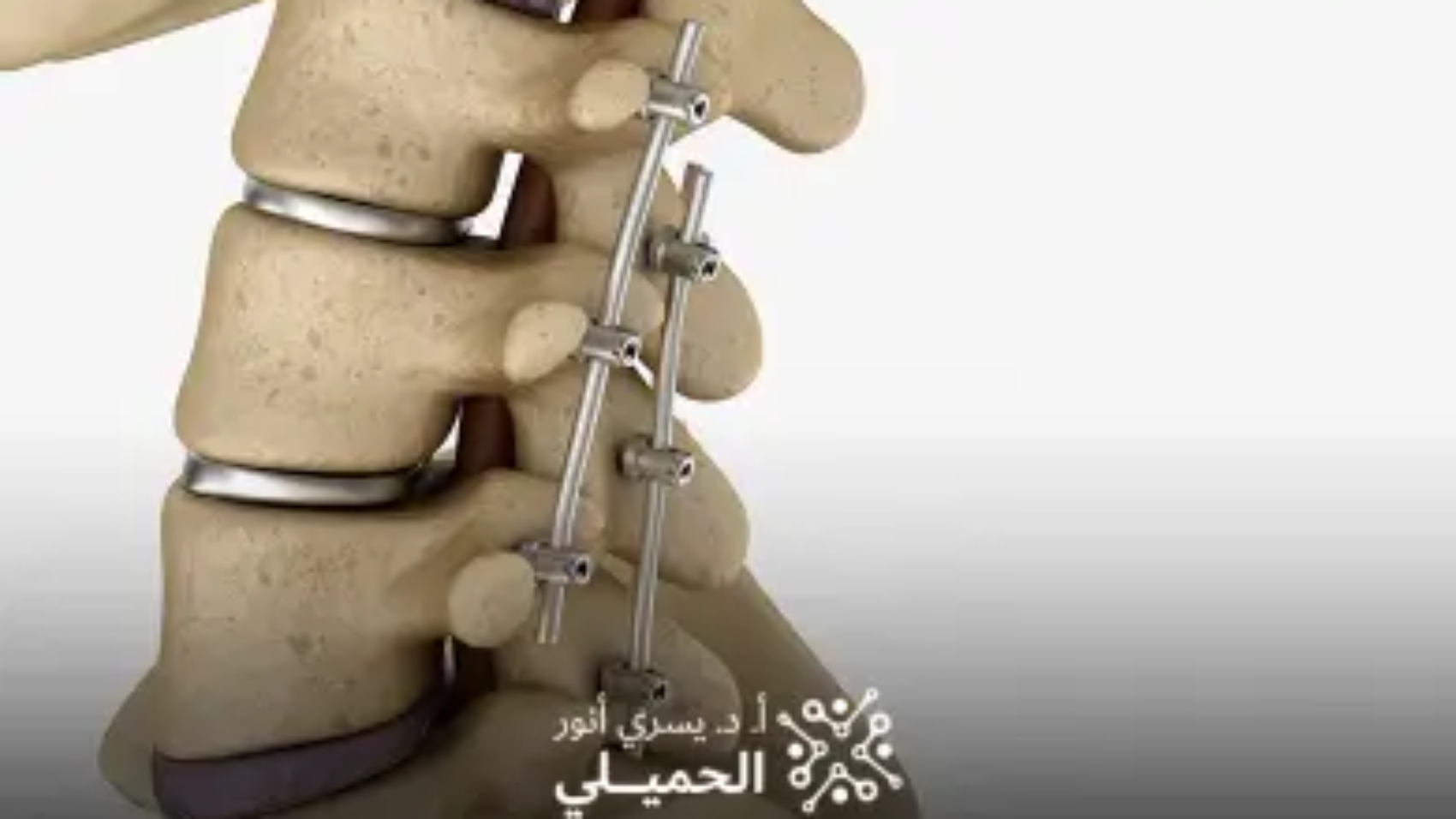 عملية-استئصال-الغضروف-وتثبيت-الفقرات