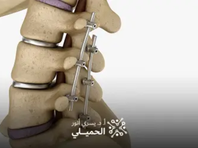 عملية-استئصال-الغضروف-وتثبيت-الفقرات