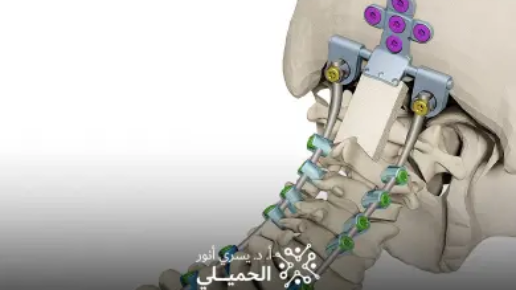 عملية-تثبيت-الفقرات-العنقية