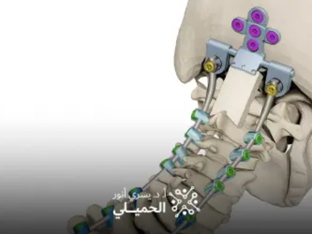 عملية-تثبيت-الفقرات-العنقية