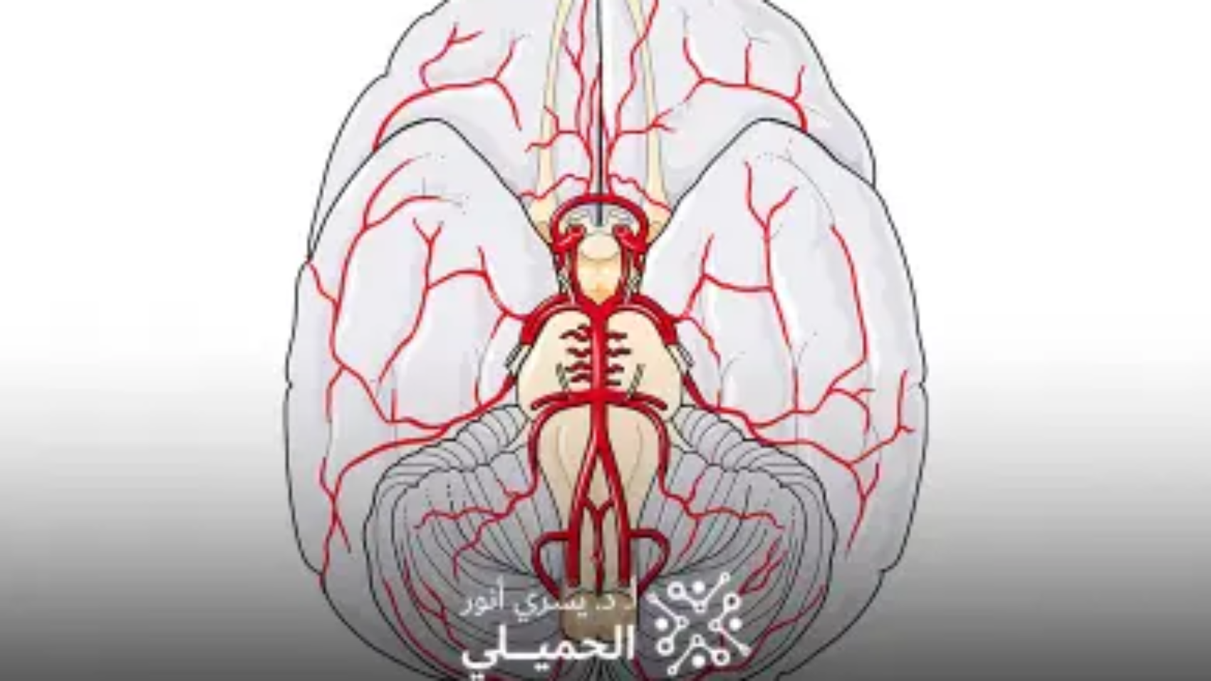 قسطرة-المخ-العلاجية