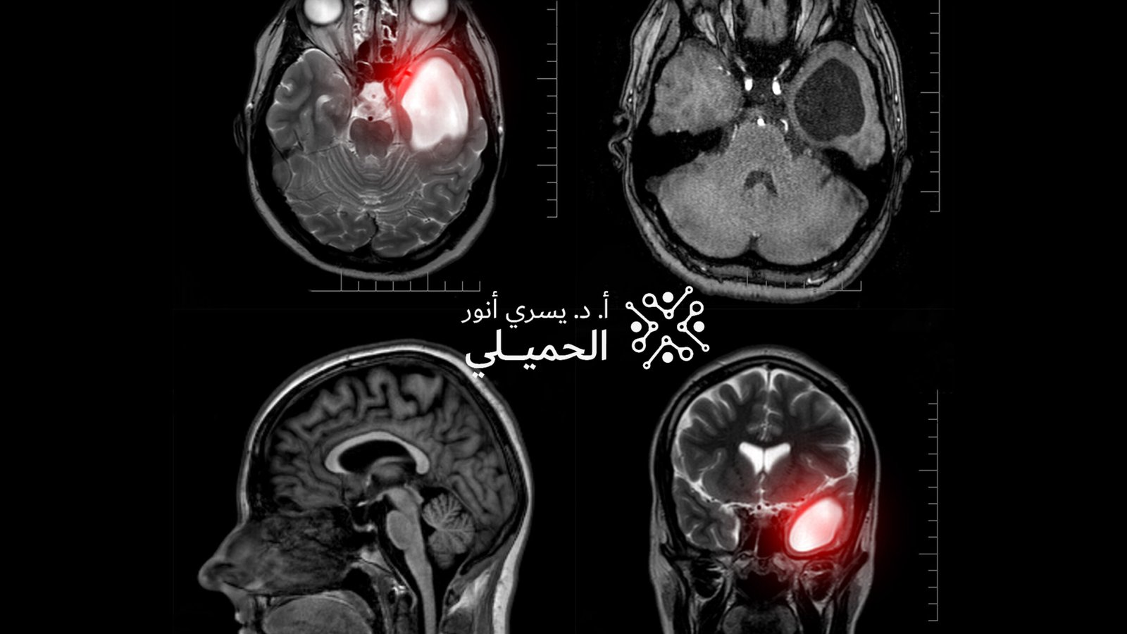 Brain-Tumor-scaled (2)