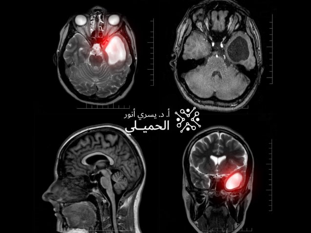 Brain-Tumor-scaled (2)