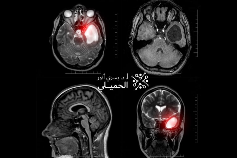 Brain-Tumor-scaled (2)
