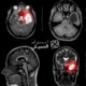 Brain-Tumor-scaled (2)