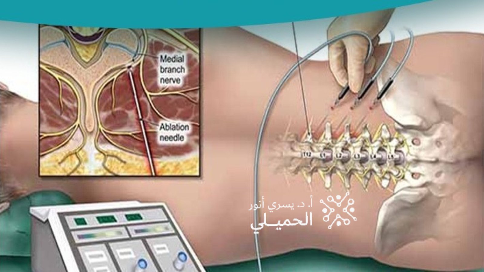 التردد الحراري لعلاج الام العصب