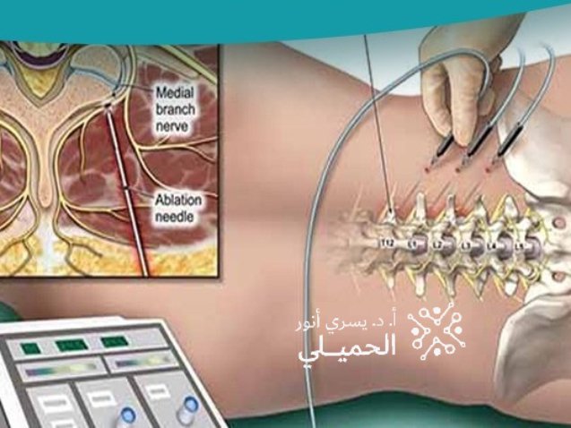 التردد الحراري لعلاج الام العصب