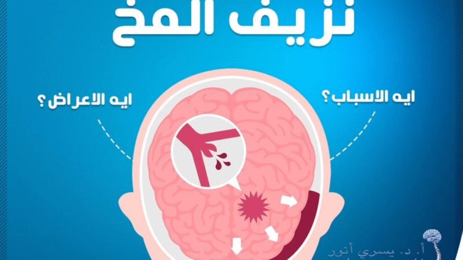 أخطر-أنواع-نزيف-المخ