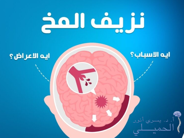 أخطر-أنواع-نزيف-المخ