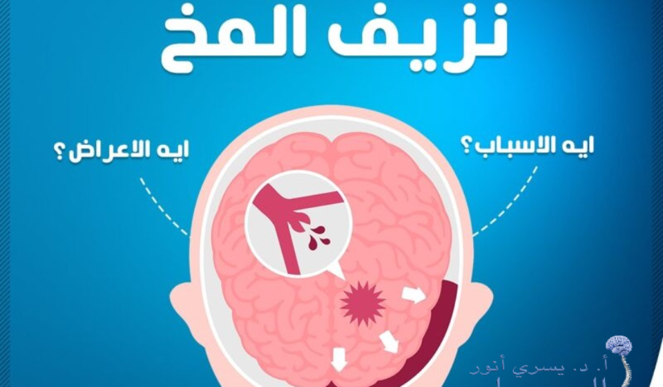 أخطر-أنواع-نزيف-المخ