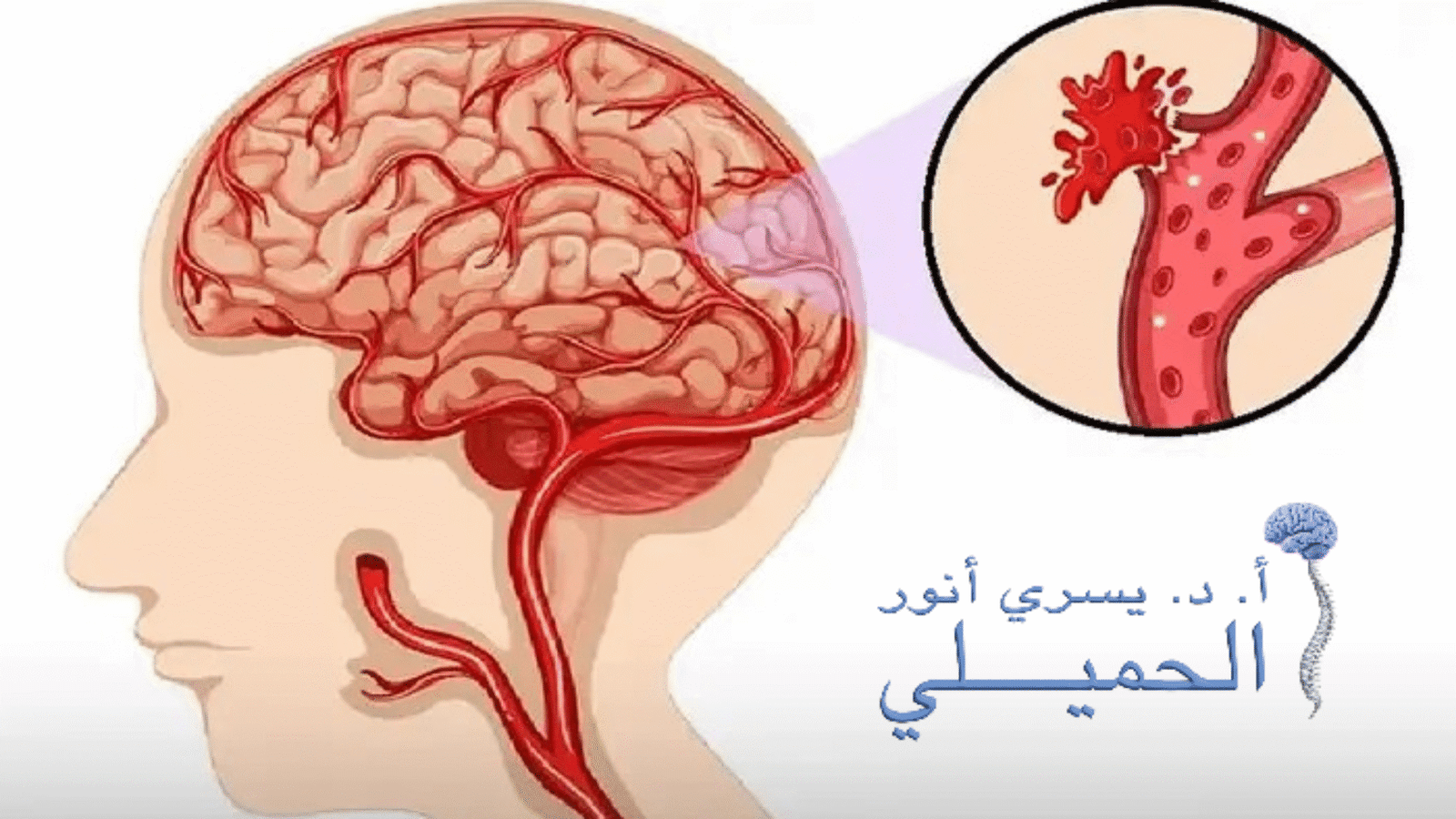 اعراض نزيف الدماغ