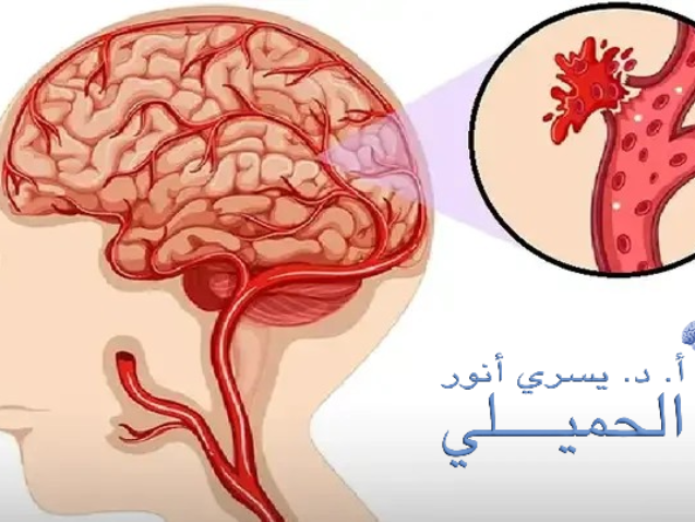 اعراض نزيف الدماغ