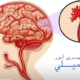 اعراض نزيف الدماغ