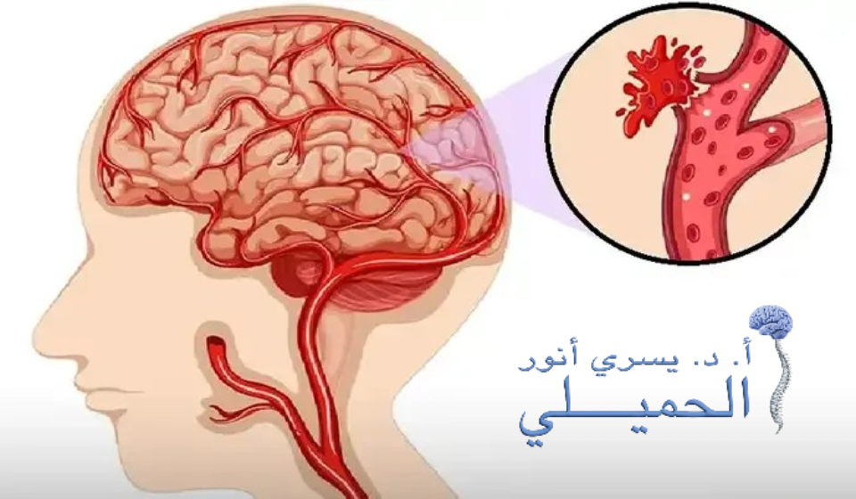 اعراض نزيف الدماغ