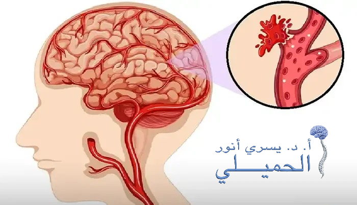 اعراض نزيف الدماغ