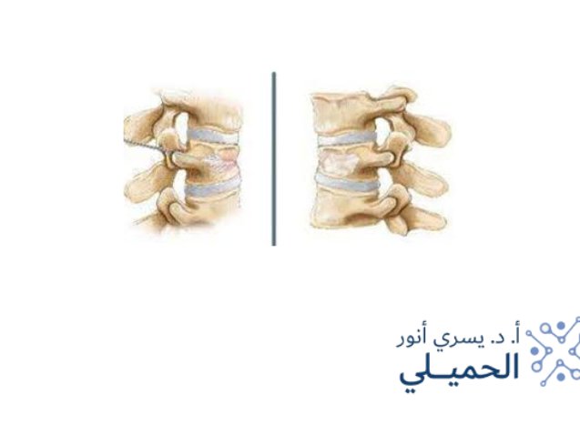 الحقن الأسمنتي للفقرات