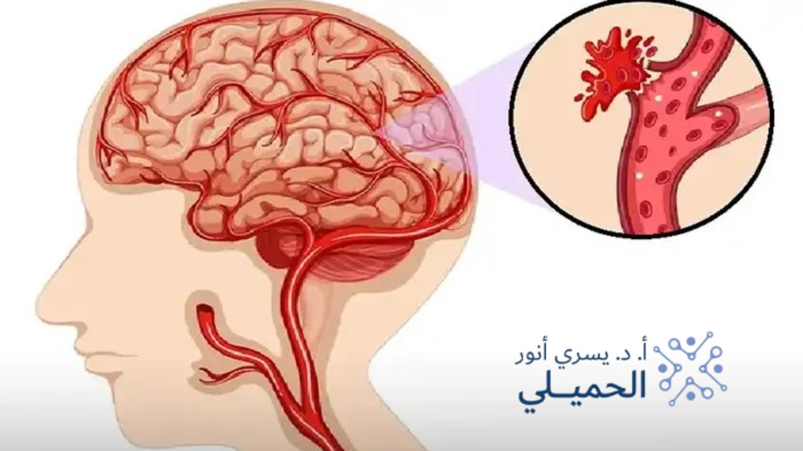 نزيف المخ أسبابه، أعراضه، طرق التشخيص والعلاج الشامل