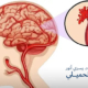 نزيف المخ أسبابه، أعراضه، طرق التشخيص والعلاج الشامل