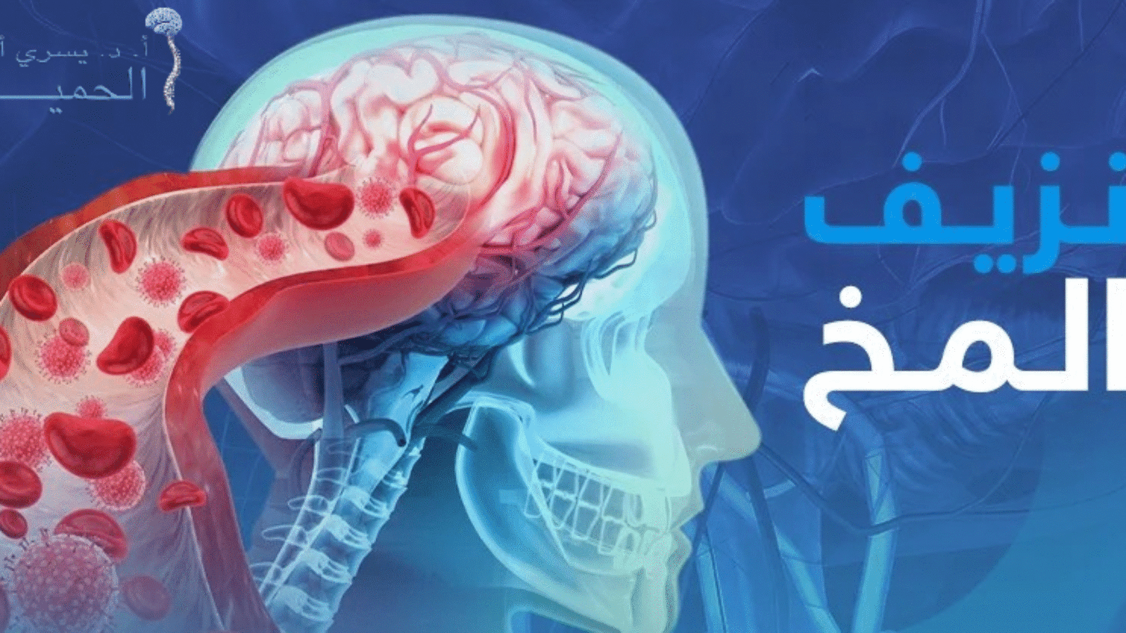 هل يمكن الشفاء من نزيف المخ