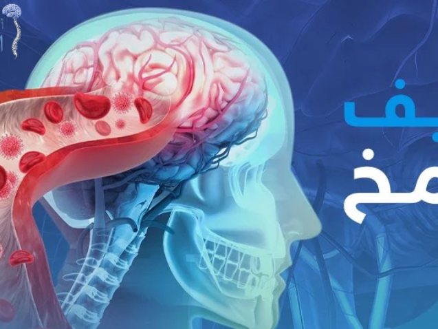 هل يمكن الشفاء من نزيف المخ