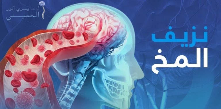 هل يمكن الشفاء من نزيف المخ