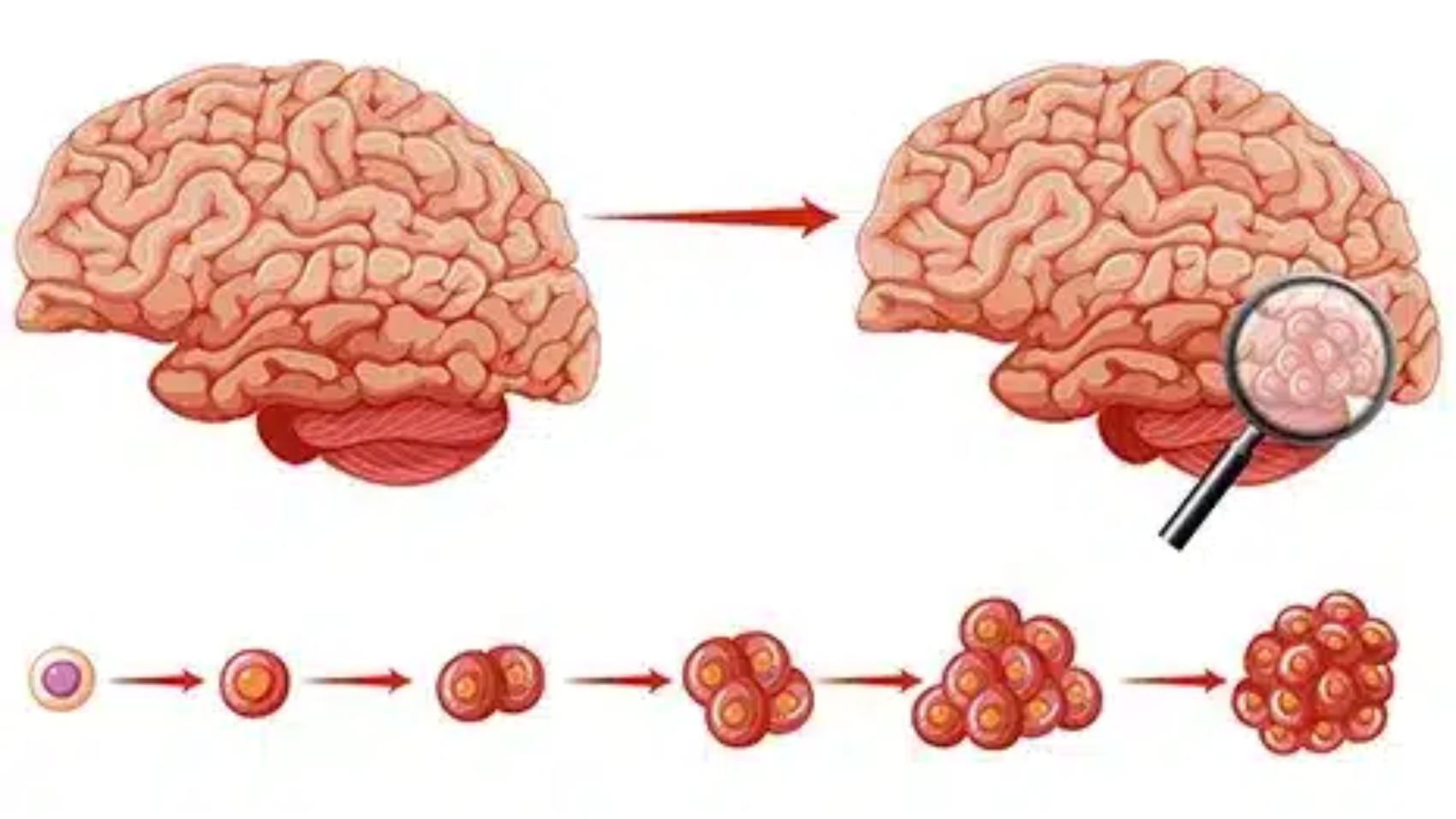 اعراض ورم الدماغ