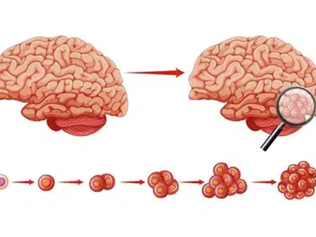 اعراض ورم الدماغ