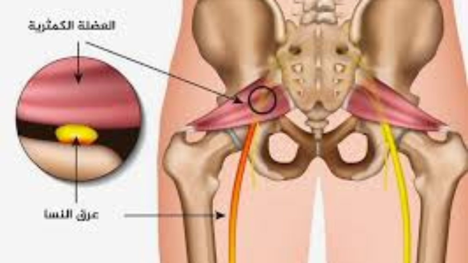 التخلص من عرق النسا نهائيا