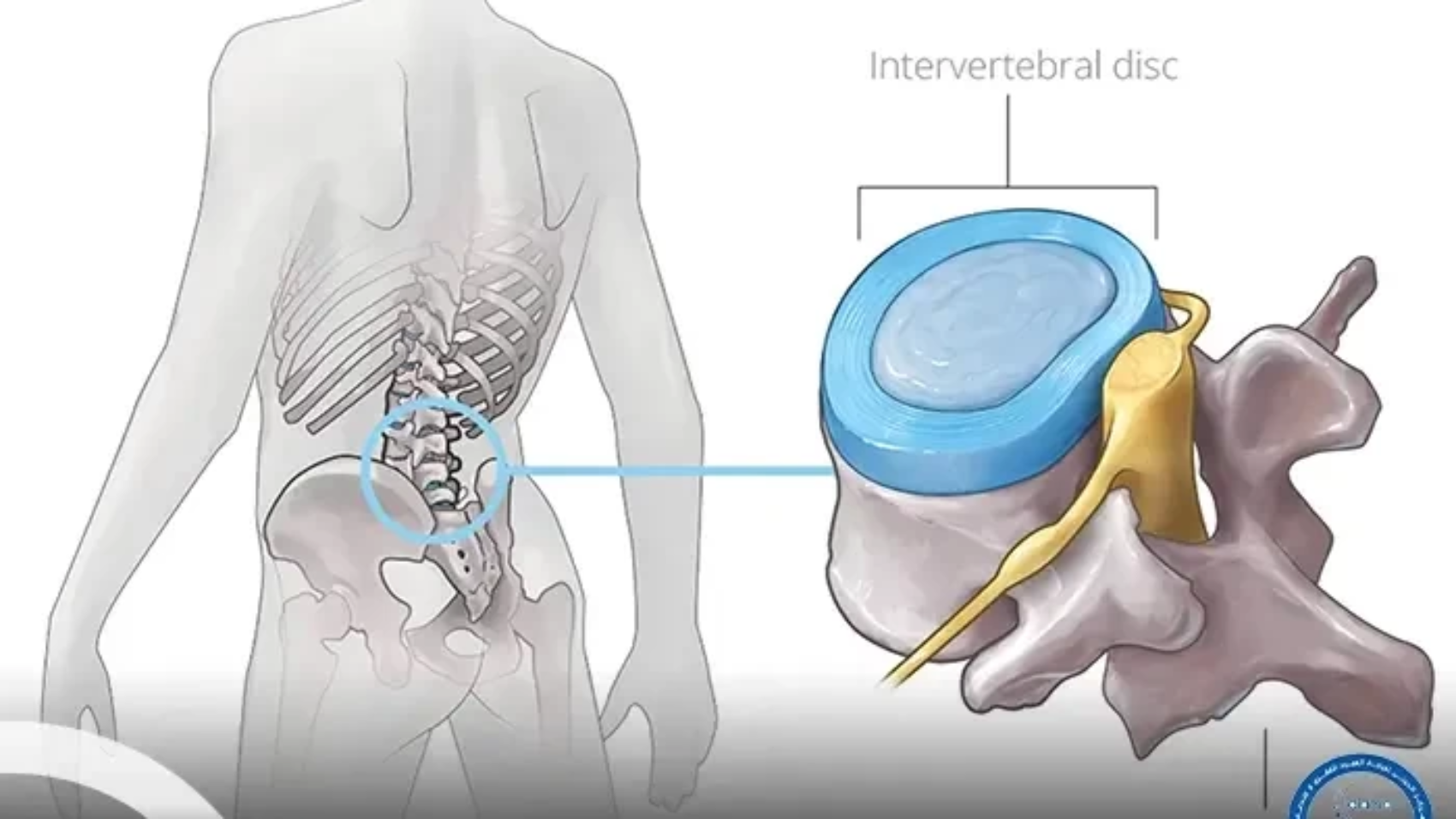 الصلاة بعد عملية الانزلاق الغضروفي