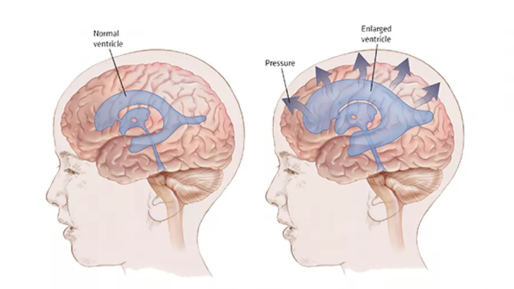 حالات شفيت من الاستسقاء الدماغي