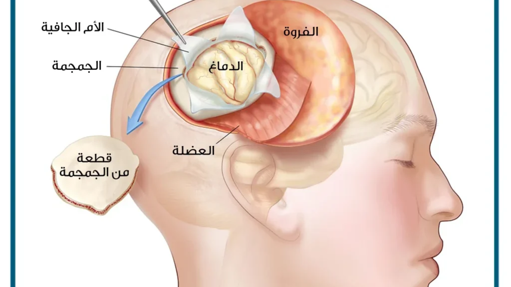 حالات شفيت من ورم الغدة النخامية