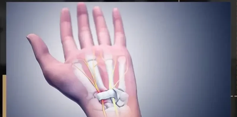 تسليك عصب اليد