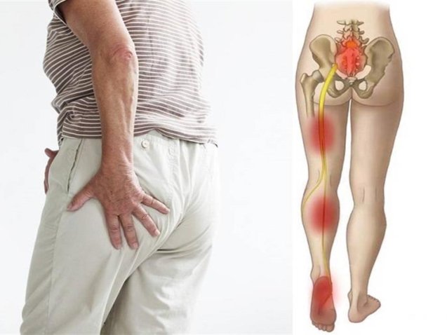 أفضل دكتور لعلاج عرق النسا