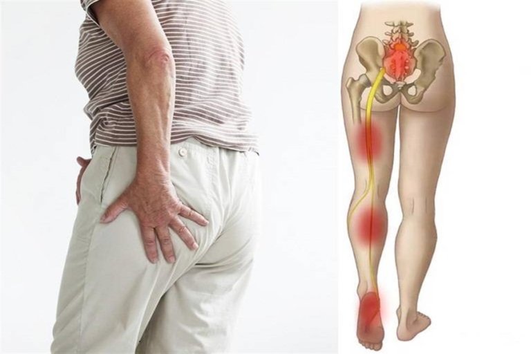 أفضل دكتور لعلاج عرق النسا