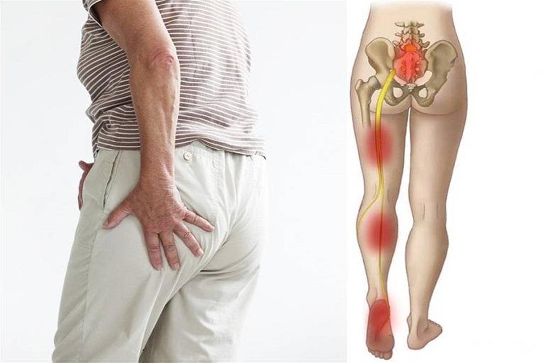 أفضل دكتور لعلاج عرق النسا