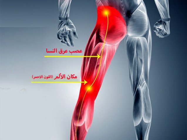 أعراض عرق النسا في الرجل اليسرى